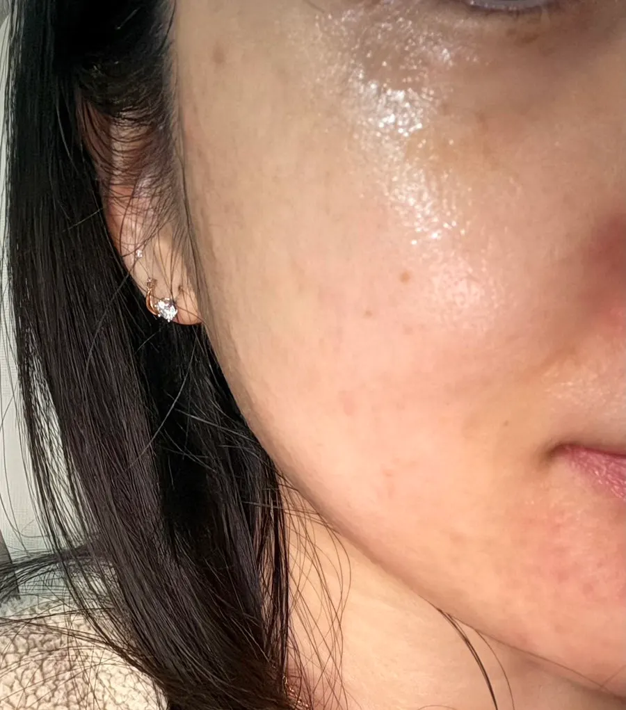 사용 전 뾰루지 상태를 기록한 피부 사진