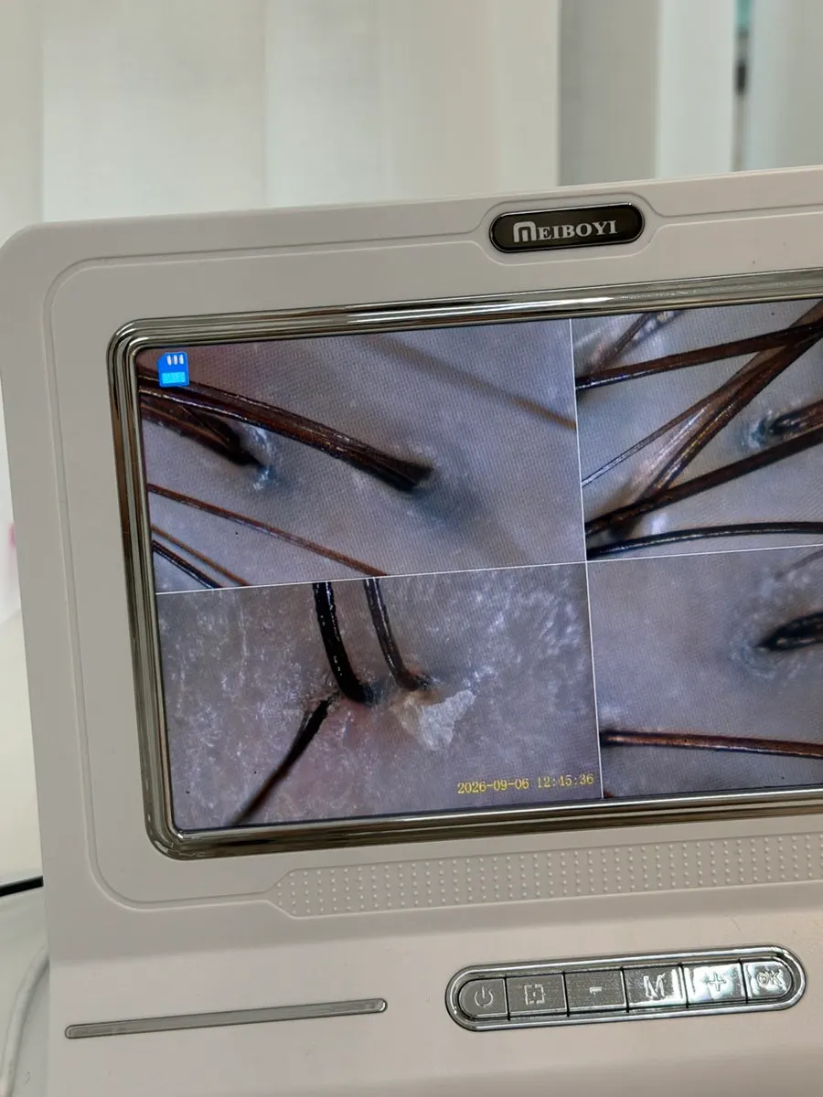 Scalp diagnosis photo showing smoother scalp after the clinic