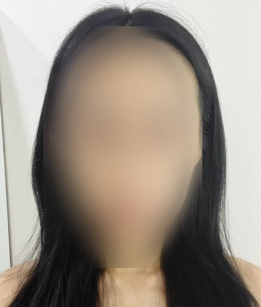 Facial line after the 3D facial contour care
