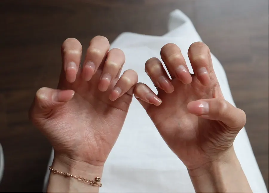 Untidy nail line before care