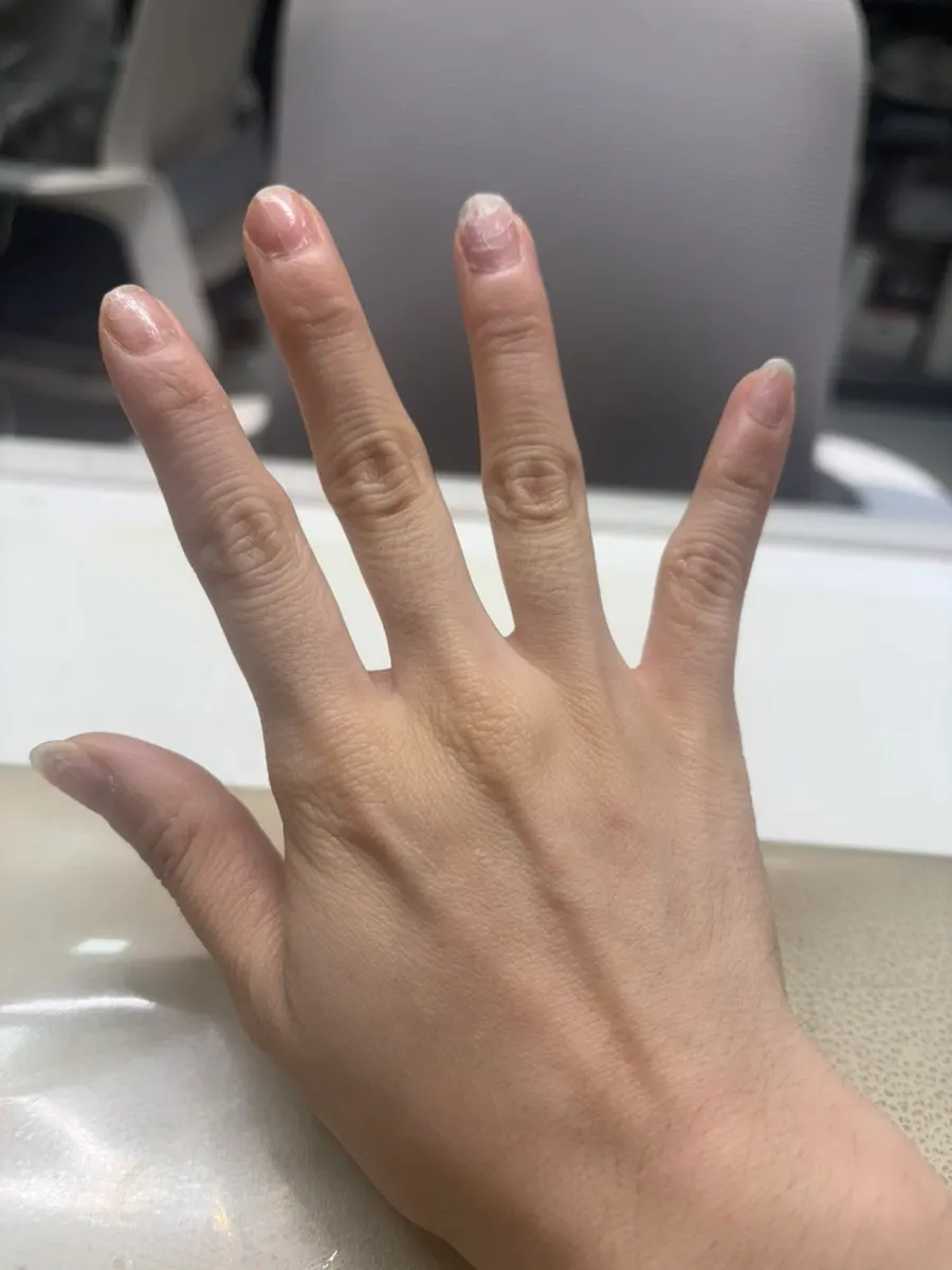 Nails with peeled layers before care