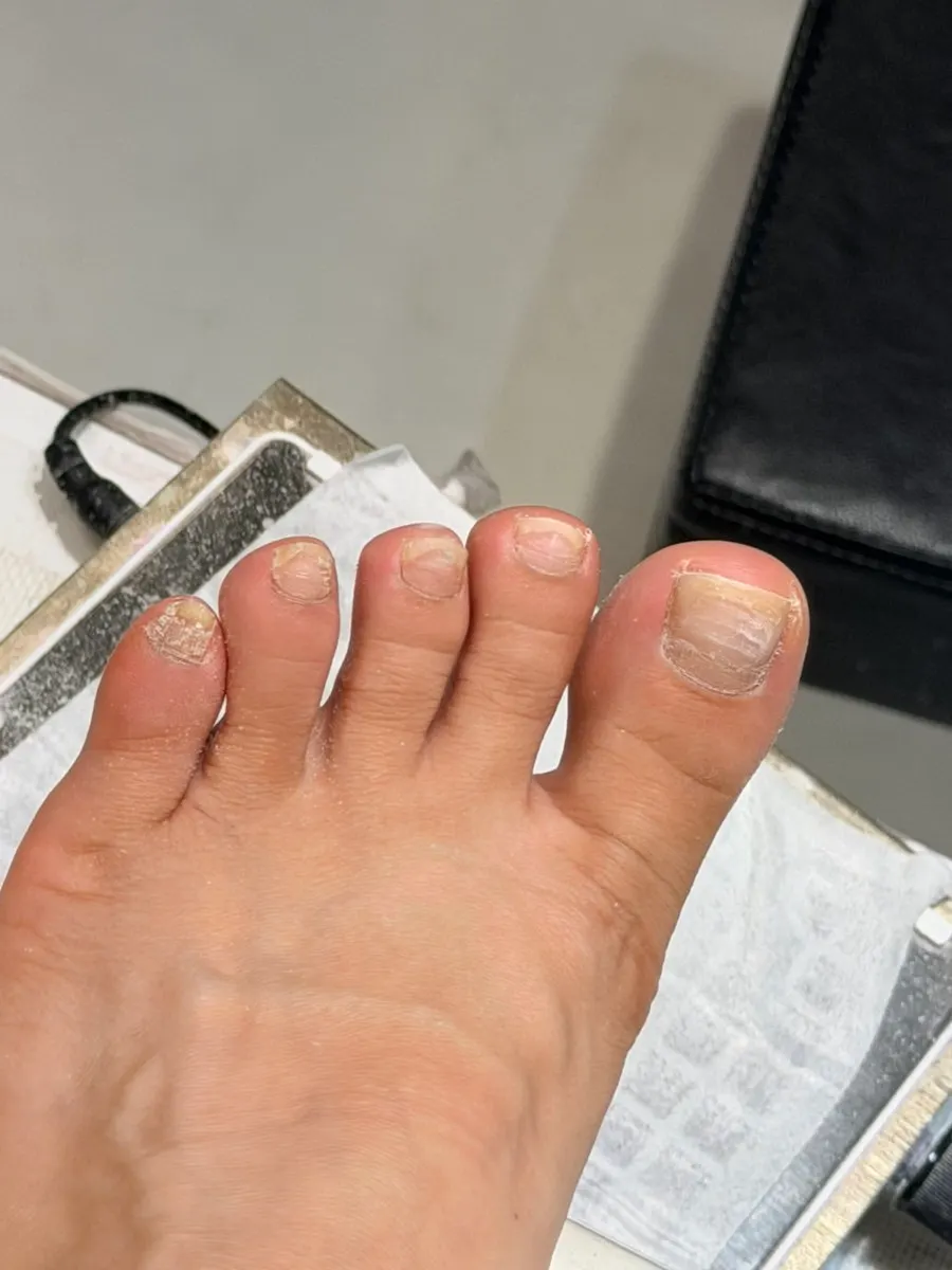Pedicure removal in progress