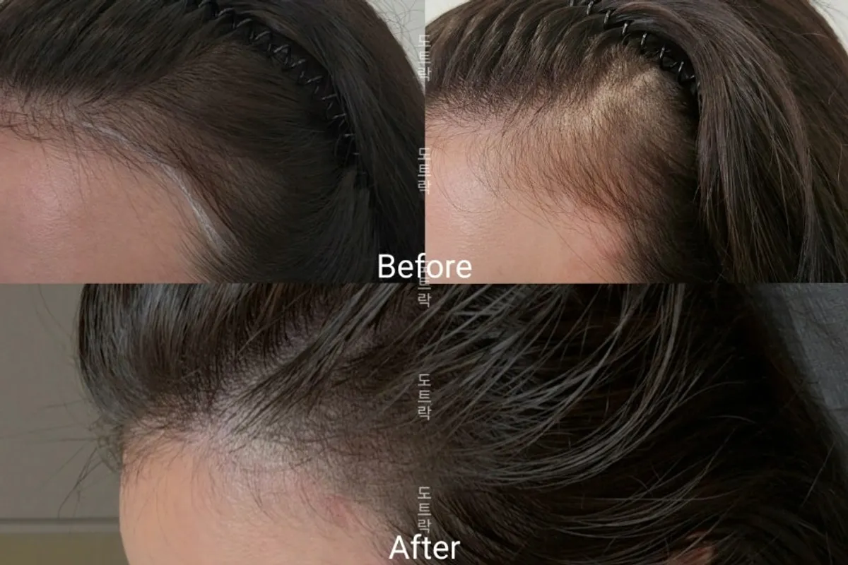 Before-and-after comparison of round 1 SMP on an M-shaped hairline