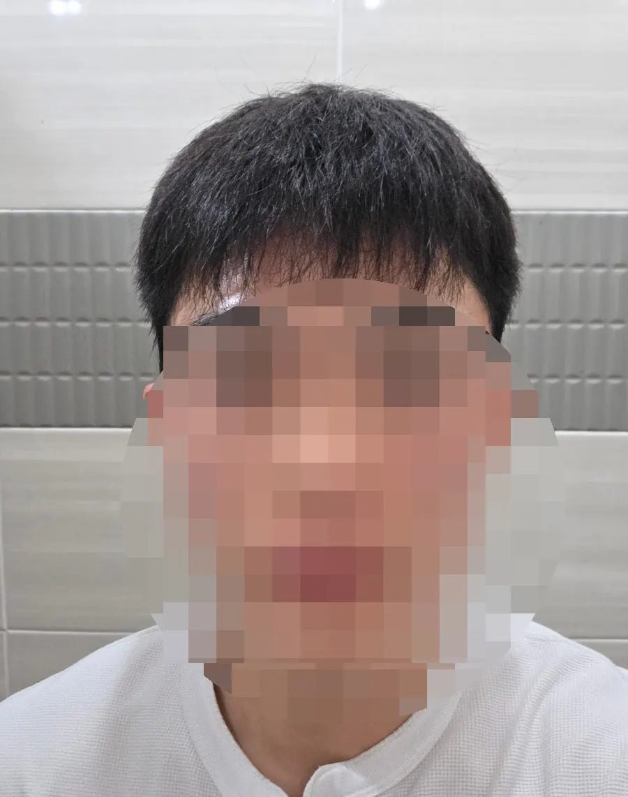 시술 전 기르던 남자 머리 상태