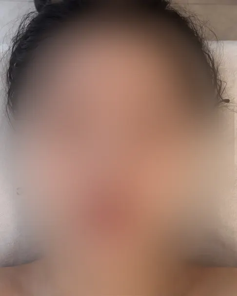 Receiving a facial contouring treatment