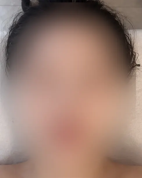 Facial line right after the V-Fit treatment