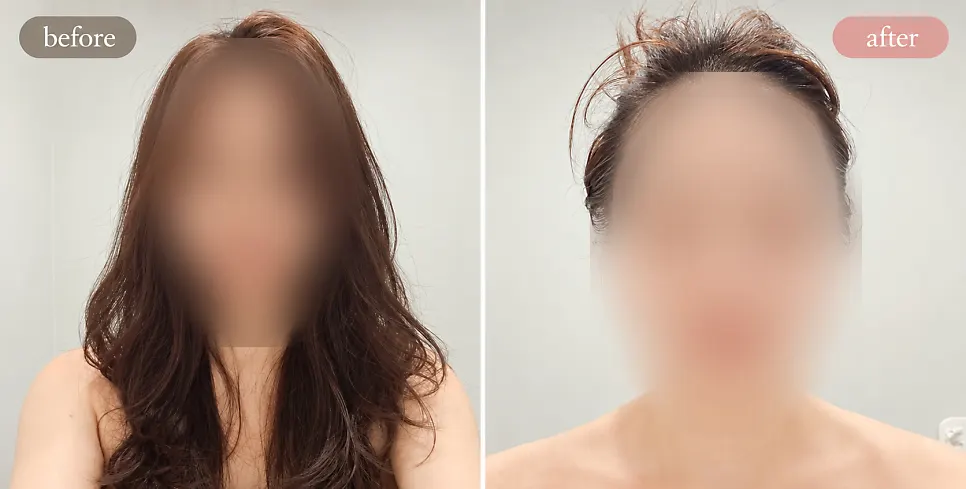 Before and after comparison photo of the Exosome treatment