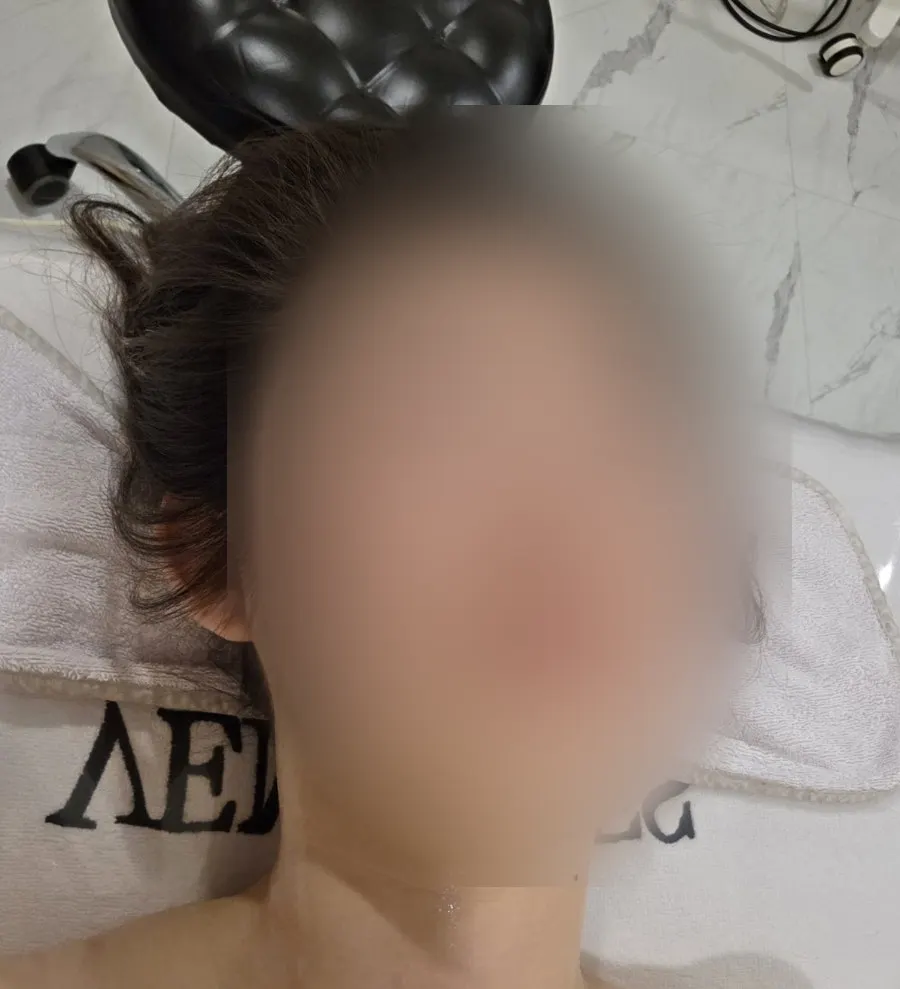Nexera peel step 1 applied to the whole face
