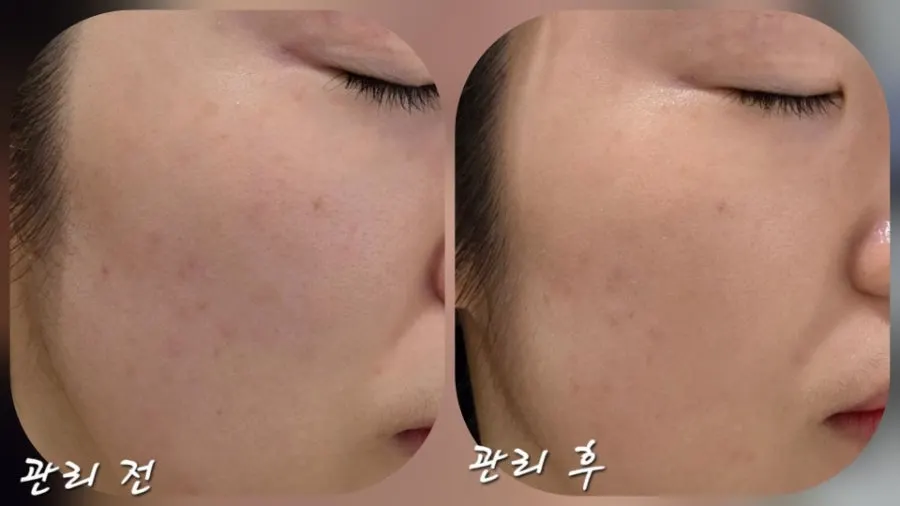 Before-and-after comparison of skin texture and calmed trouble