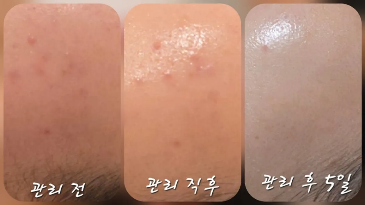 Skin change showing calmed trouble by day 5 of care