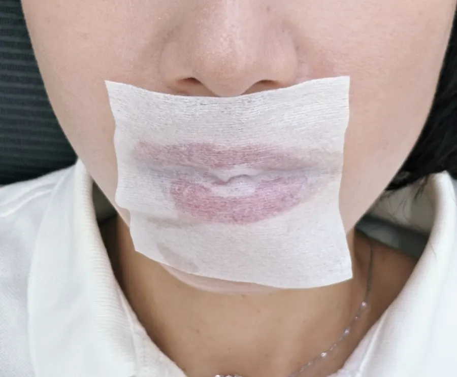 Air-pressure air-gun lip-plumping treatment process
