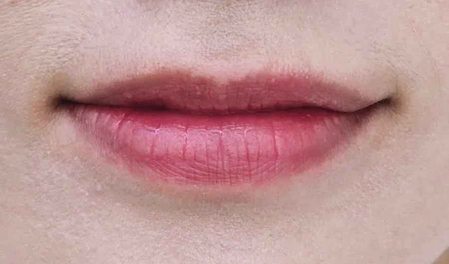 Before-and-after comparison of lip-plumping treatment