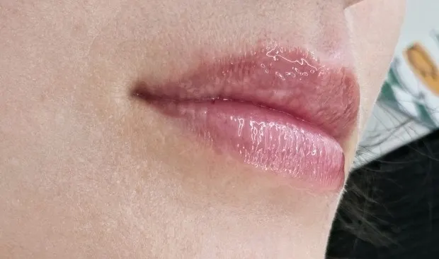 Dry, flaky lips before treatment
