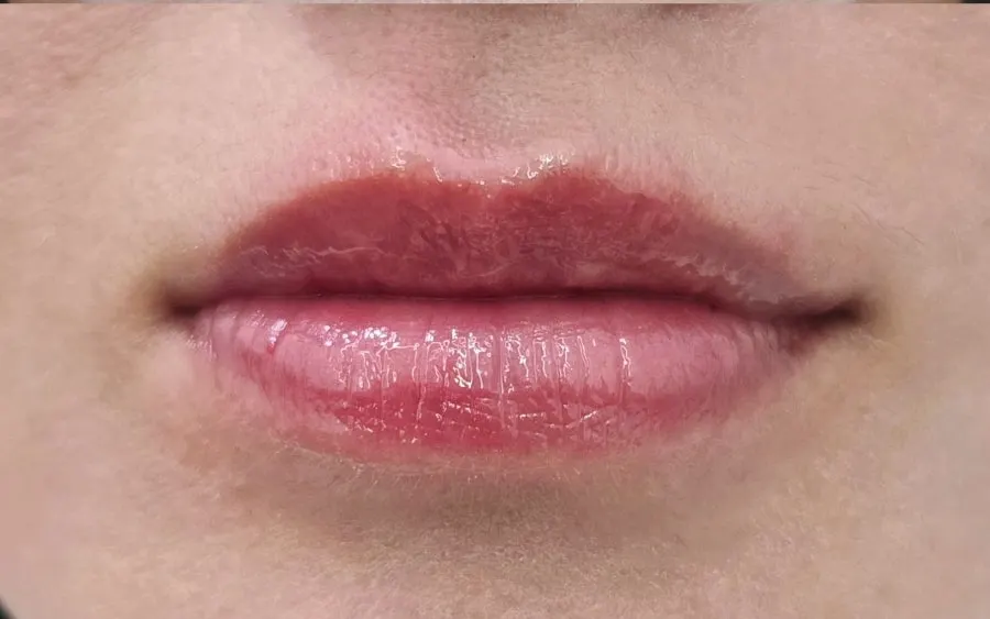 Dry, flaky lips before treatment