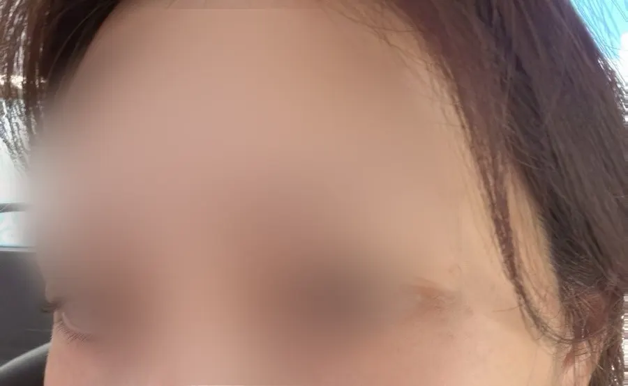 뒤쪽이 비어 있는 시술 전 눈썹 클로즈업