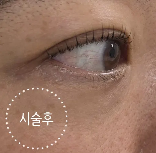 케라틴앰플펌으로 자연스럽게 올라간 속눈썹 컬