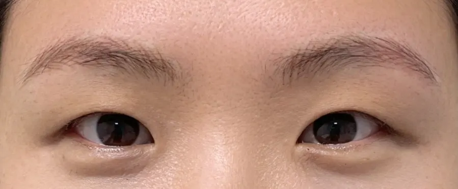 헤어스트록 시술 진행 장면