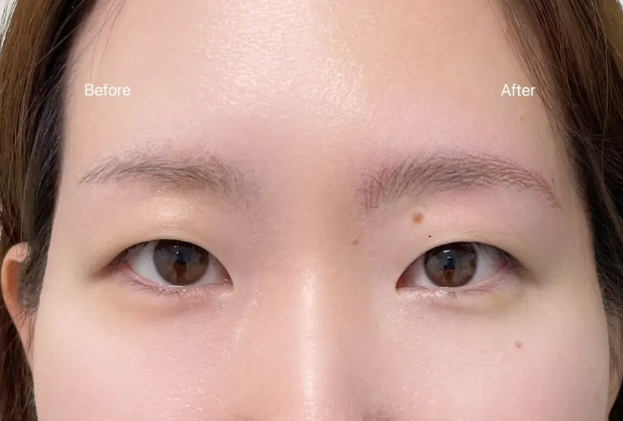 Eyebrows right after the hair stroke tattoo procedure