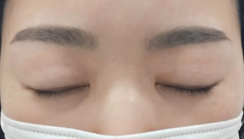 Signature combo brow procedure in progress