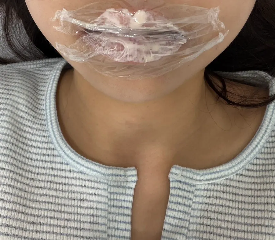 솜으로 입술을 막고 진행하는 마취 과정