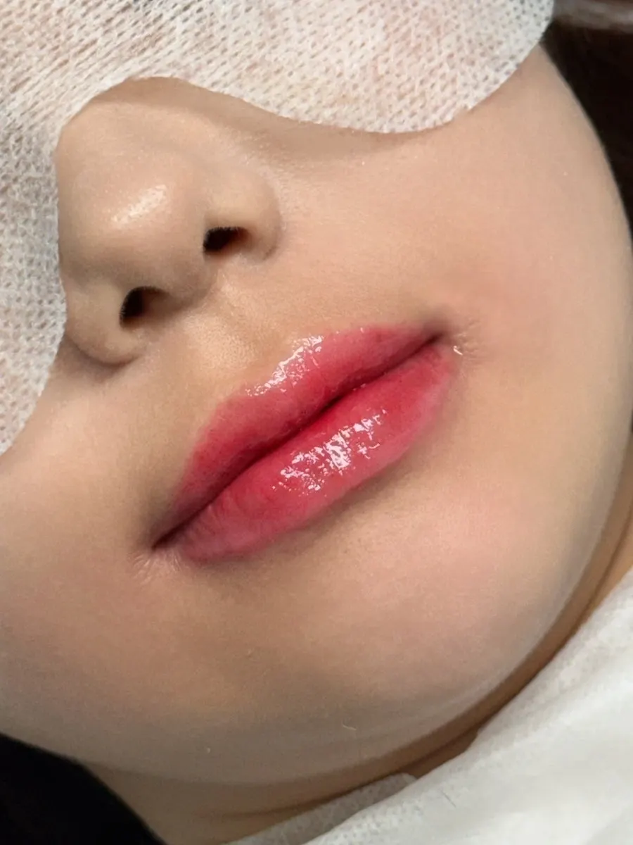 시술 직후 생기 있는 입술 셀카