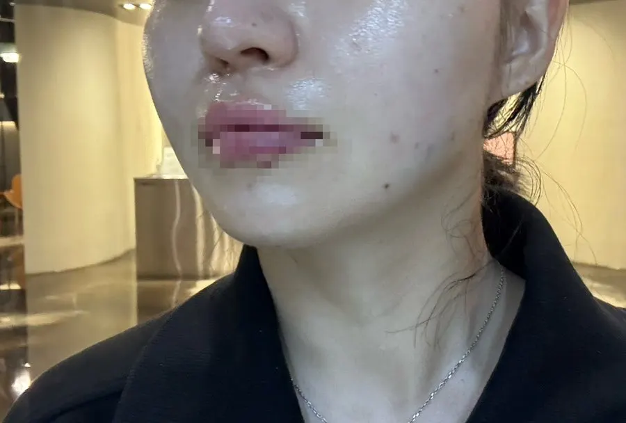 Complexion looking calmer after the treatment