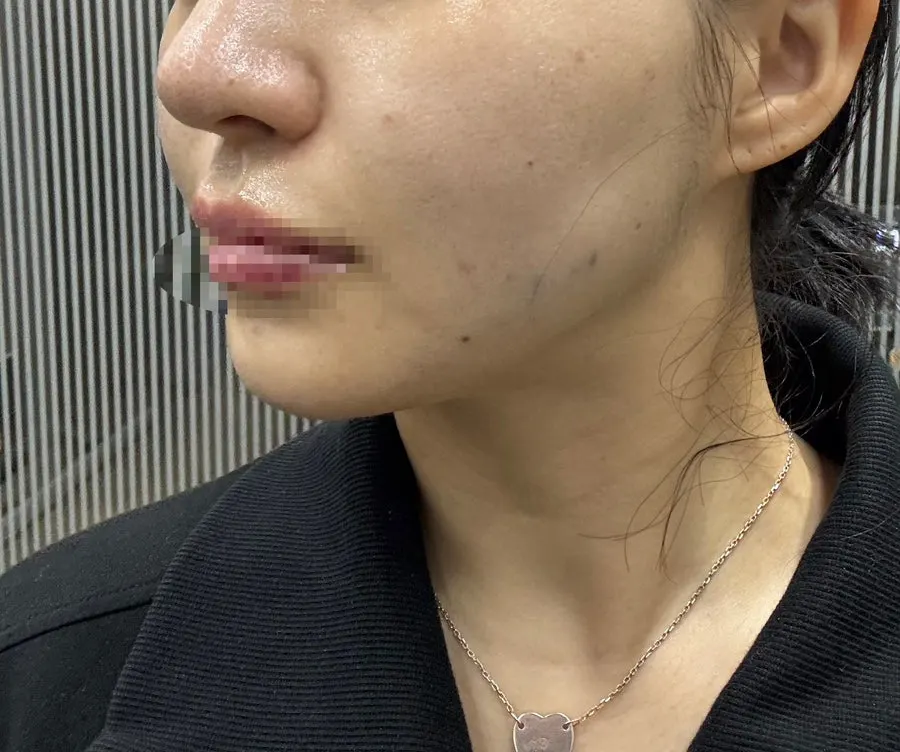 Skin with reduced redness after the treatment