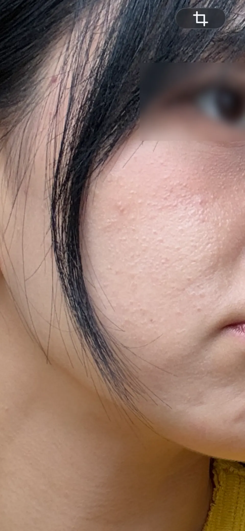 Face before care showing tiny bumpy acne