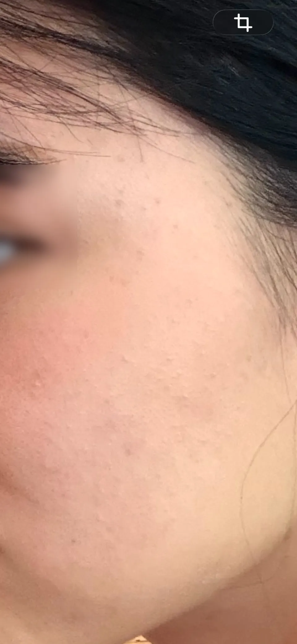 Bumpy acne visible across the whole face even with makeup on