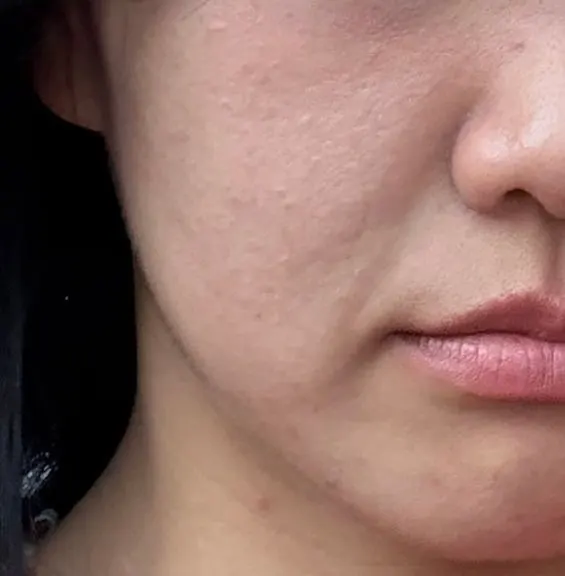 Skin before treatment with bumps covering cheeks and chin