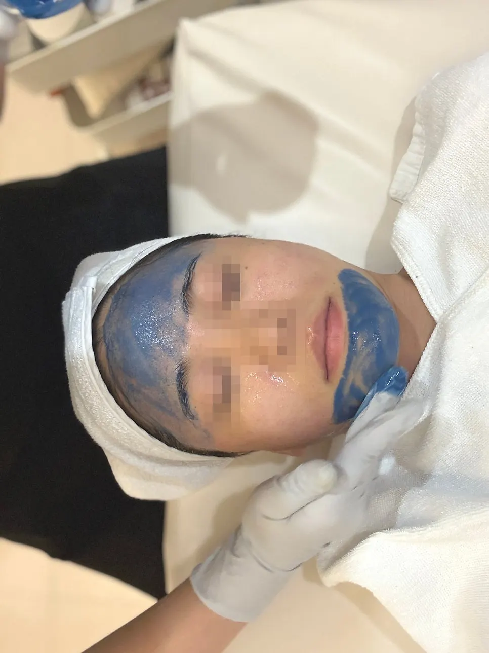 Face during Blue Peel microneedling application