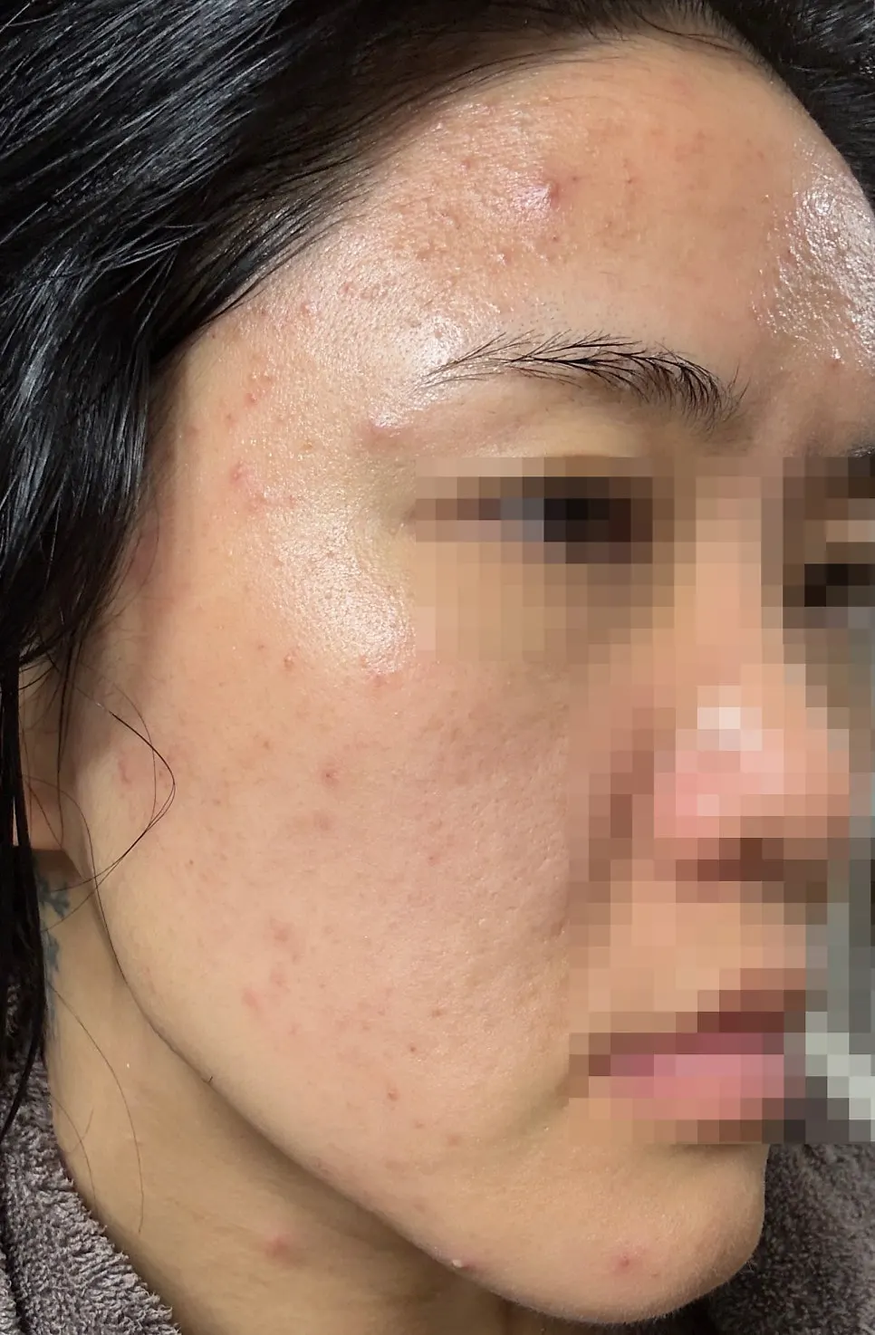 Skin 3 days after care with sebum surfacing