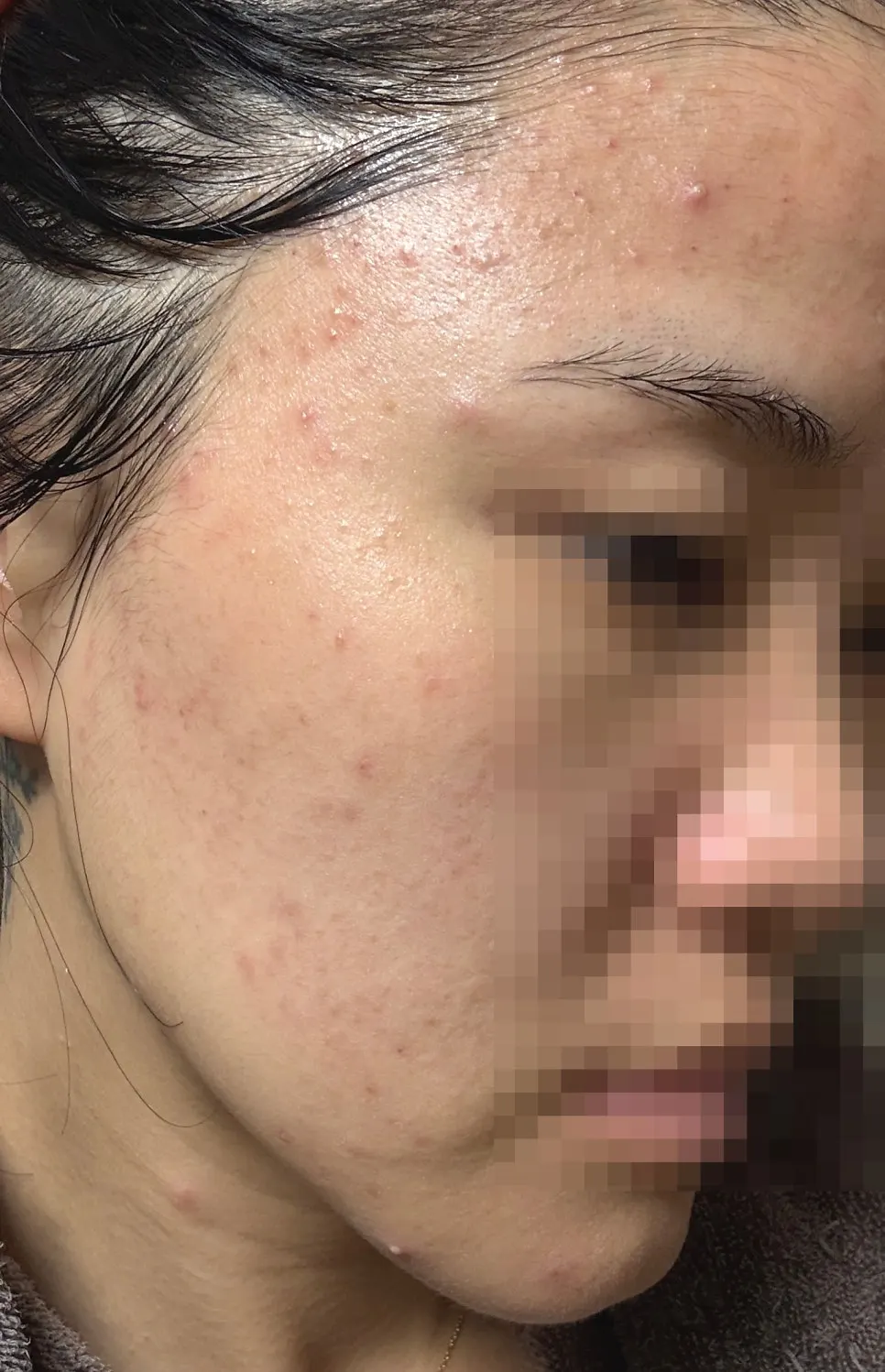 Yellow sebum and pimples on day 3 of Blue Peel
