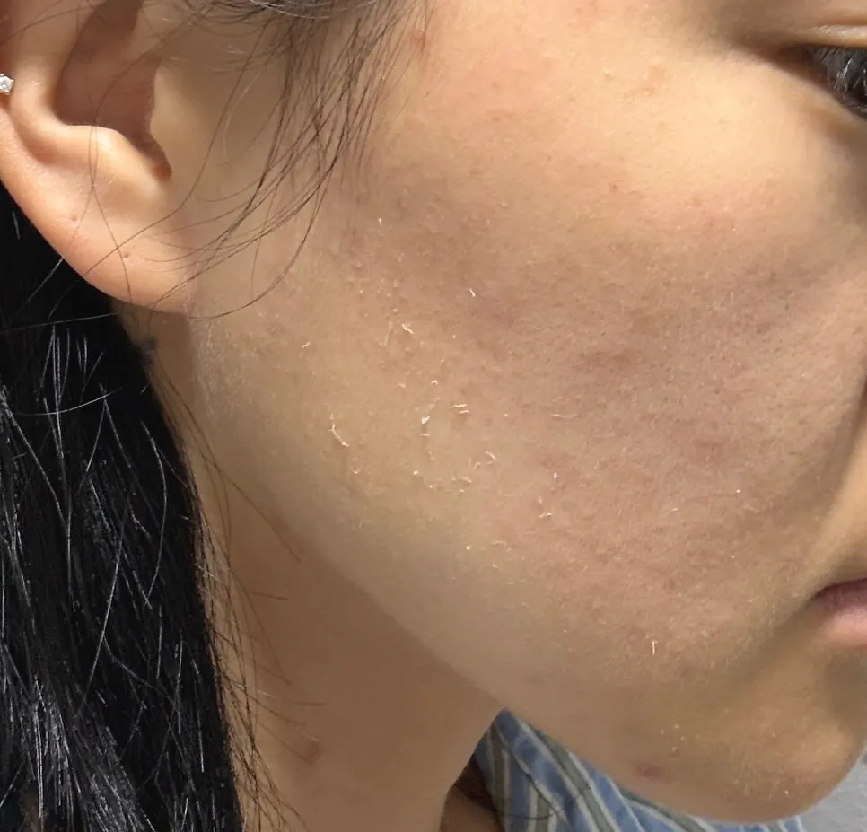 Skin 5 days after care with redness calmed down