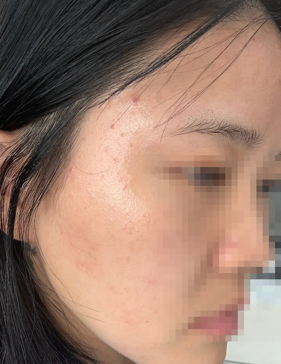 Face one week into Blue Peel with fewer bumps