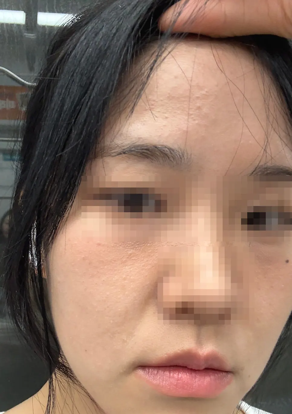 Skin texture smoothed out one week after care