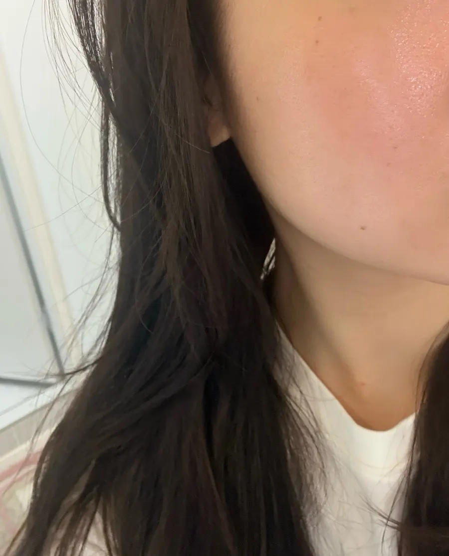 Before and after comparison of skin texture after the aquapeel
