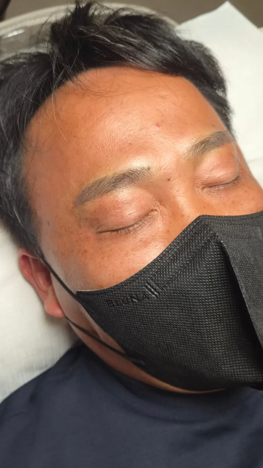 Front view immediately after the semi-combo eyebrow tattoo