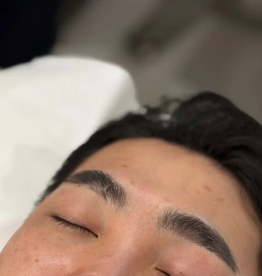 Comparison of left line-type embo and right combo brows