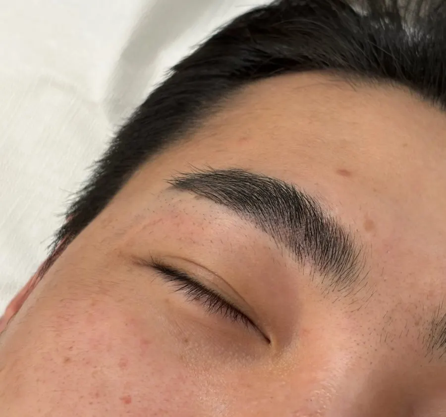 Right eyebrow with shading added over the scarred area