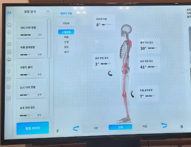 Side-view posture analysis result screen showing reduced thoracic curve and forward lumbar tilt