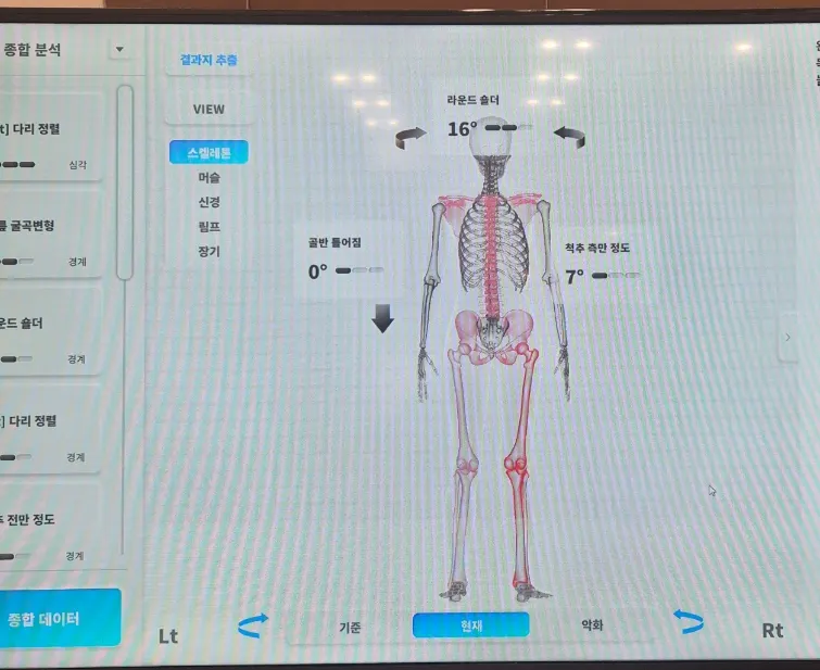 Back-view posture analysis result screen showing scoliosis
