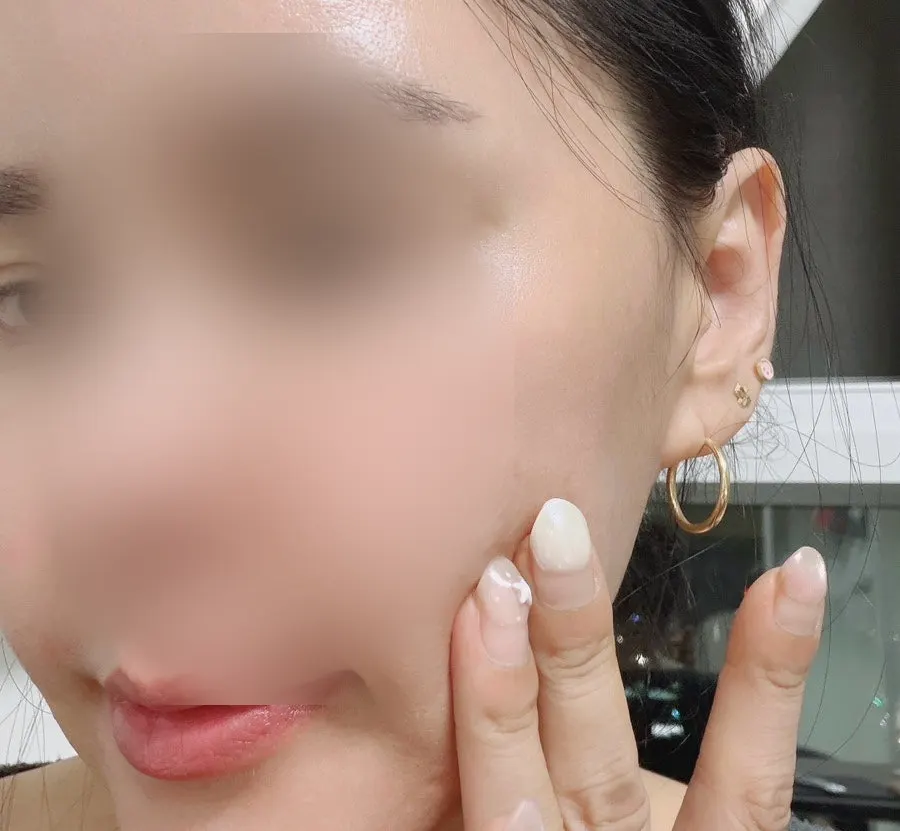 Hydration and calming care step after using the sebum patch