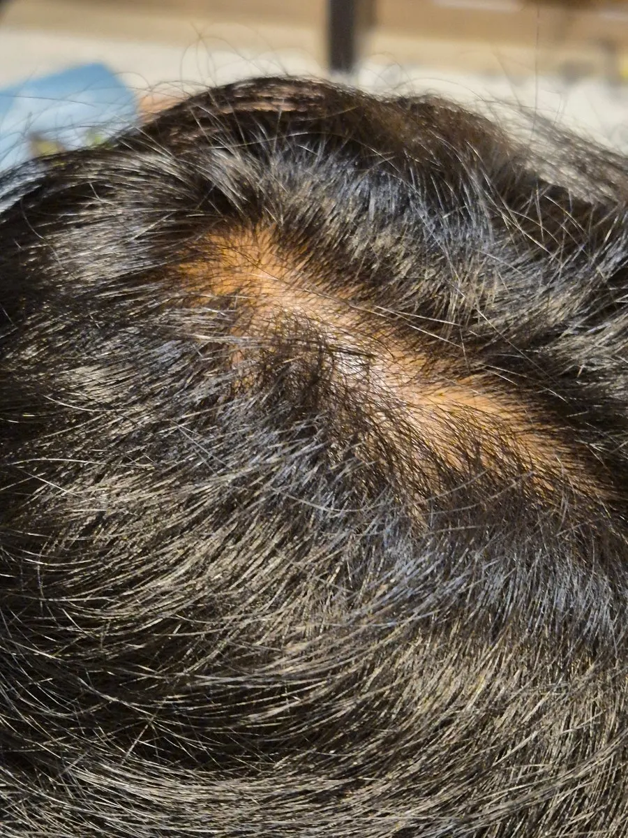 Consultation on my husband’s scalp condition