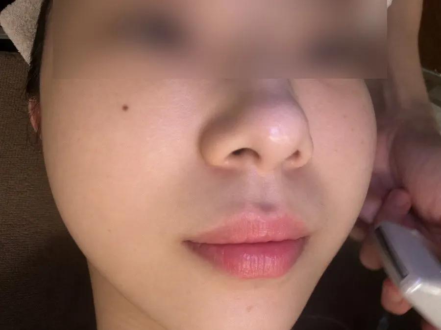 去角质后的皮肤状态