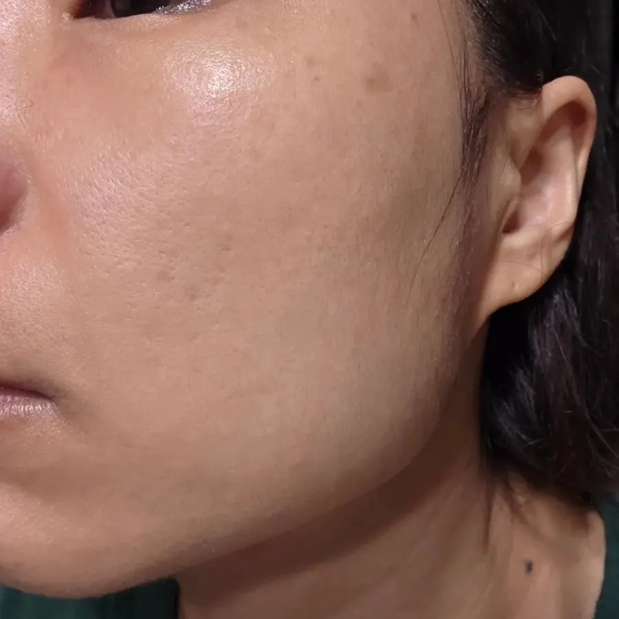 Skin right after cleansing with the oil