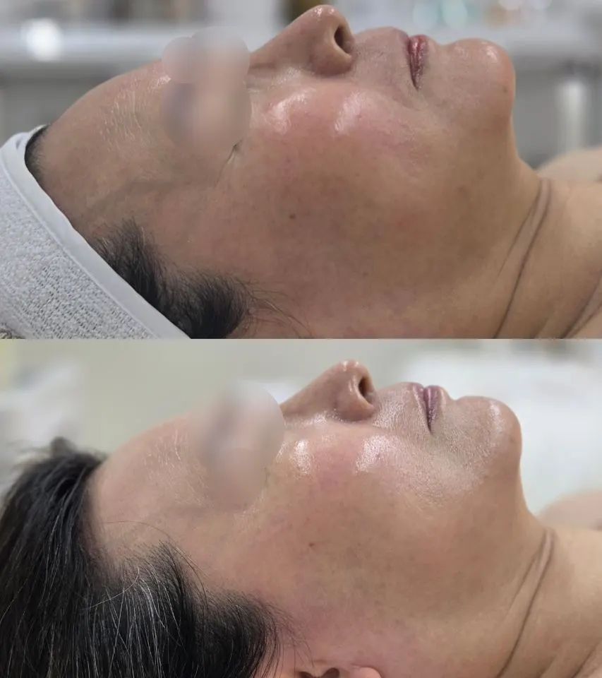 Moisture-filled skin texture after treatment