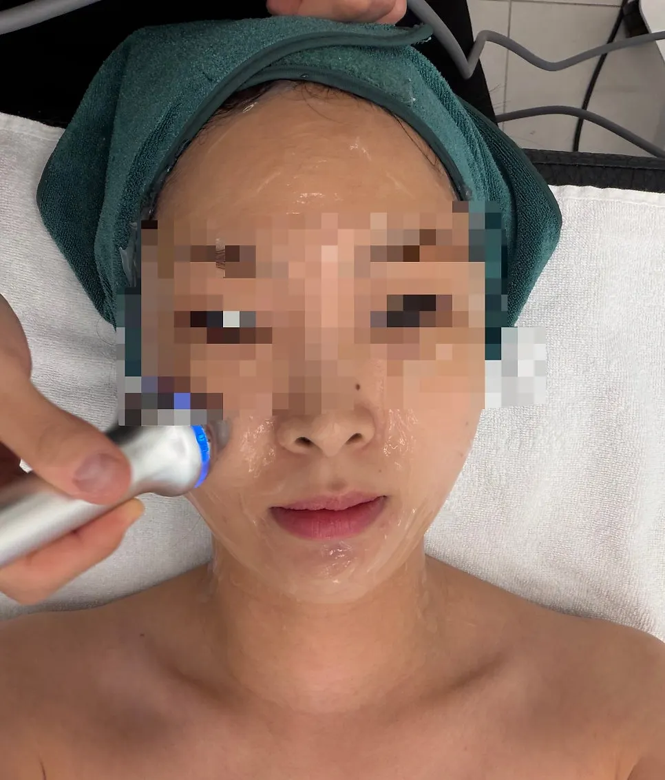 HIFU treatment for the double chin and lower cheeks