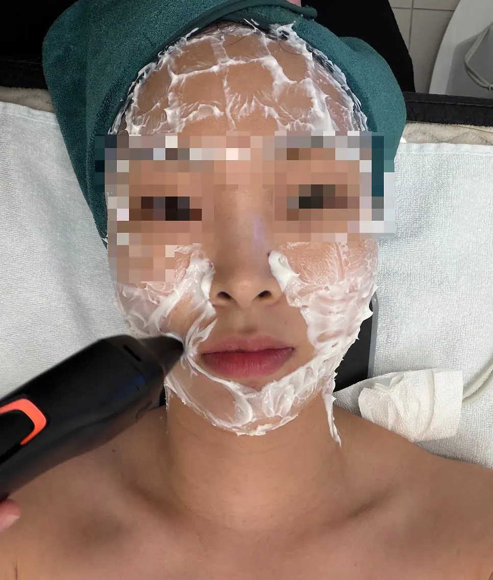 Thermajet treatment tailored to different facial areas