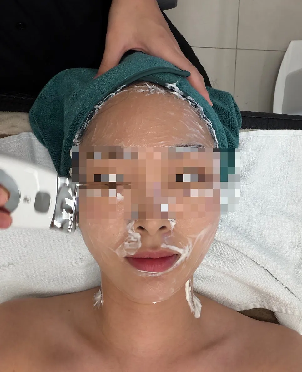 Eye Thermajet treatment around the eyes and mouth